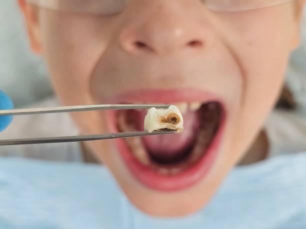 Best Emergency Wisdom Teeth Removal in Shamokin Dam, PA